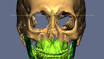 3D Virtual Surgery